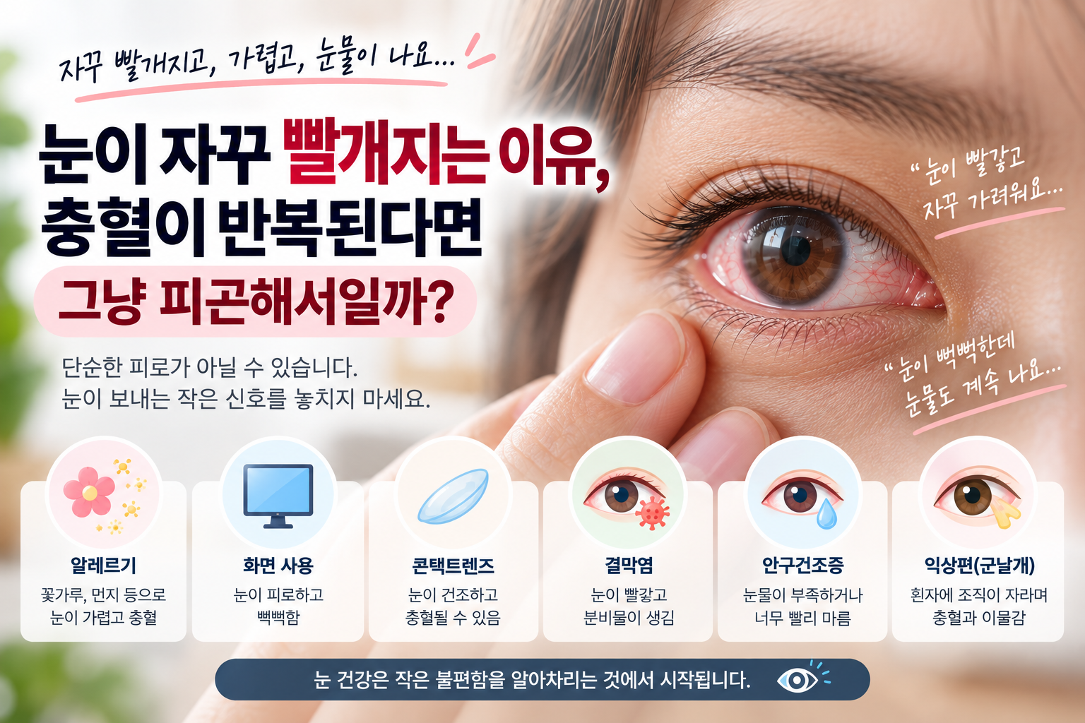 눈이 자꾸 빨개지는 이유, 충혈이 반복된다면 그냥 피곤해서일까?